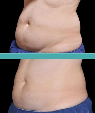 Before and After Fat Reduction of Female Patient-Coolsculpting