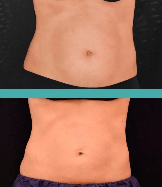 Before and After Fat Reduction of Abdomen