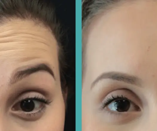 Botox Before And After Treatment of forehead lines