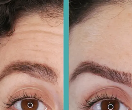 Wrinkles reduced before and after treatment of Botox