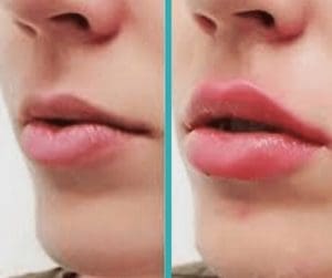 Lip-Injections-Chicago-Before-and-After-.jpg