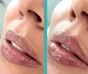 Before And After Lip Augmentation in Female patient