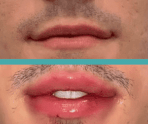 Male patient before and after of lip fillers