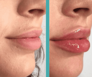 Before And After Lip Augmentation in Female in Chicago