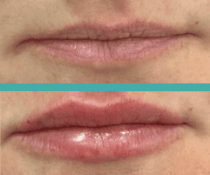 Before And After Lip Fillers in Elite Chicago Spa