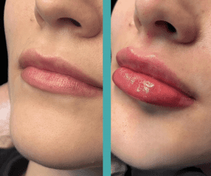 Before And After Lip Augmentation in Female patient in Chicago