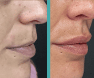 Before And After Lip Fillers in Woman in Chicago