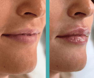 Female Patient Before And After Lip Injections in Elite Chicago Spa