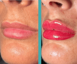 Woman with hot pink Lips Before And After her lip filler in chicago