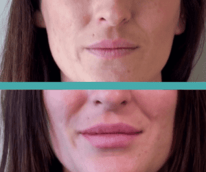 Before And After Results of Lip Filler in Elite Chicago Spa