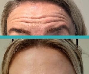 botox.jpg