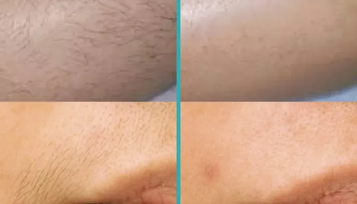How Many Sessions For Laser Hair Removal