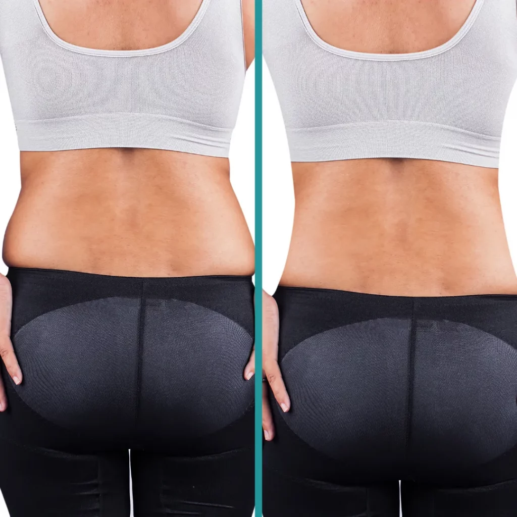 how-much-fat-does-coolsculpting-reduce-per-session