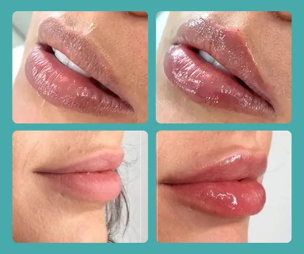 how-long-does-swelling-last-after-lip-filler