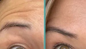 Read more about the article How Long Does Botox Last?