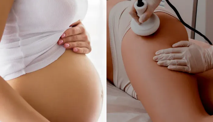 You are currently viewing Can You Get Laser Hair Removal while Pregnant?