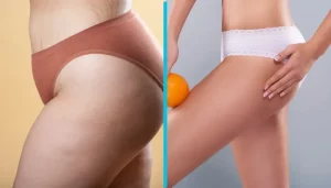 Read more about the article Does CoolSculpting Work on Cellulite?
