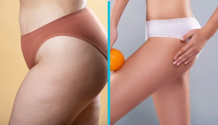You are currently viewing Does CoolSculpting Work on Cellulite?