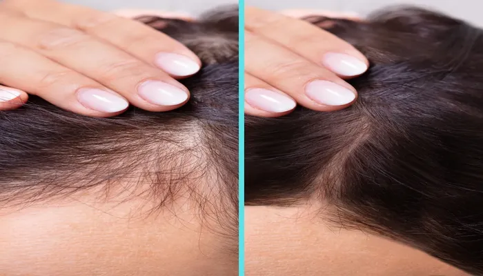 You are currently viewing What Depth Should You Microneedle For Scalp Be?