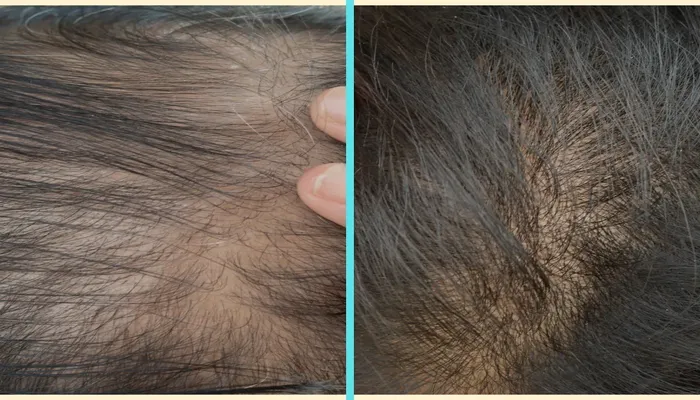 You are currently viewing What Is Hair Botox?