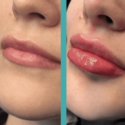 Before And After Lip Augmentation in Female patient in Chicago