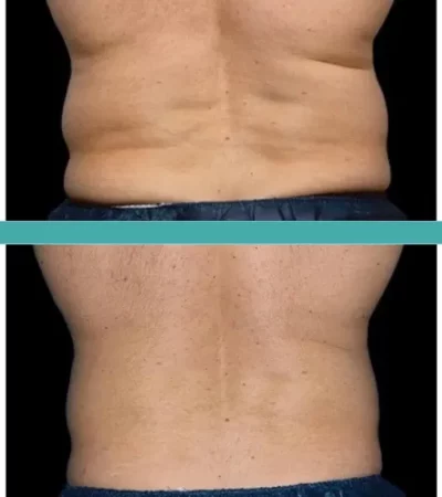 Before-and-After-Fat-Reduction-of-Male-Patient-Elite-Chicago-Spa