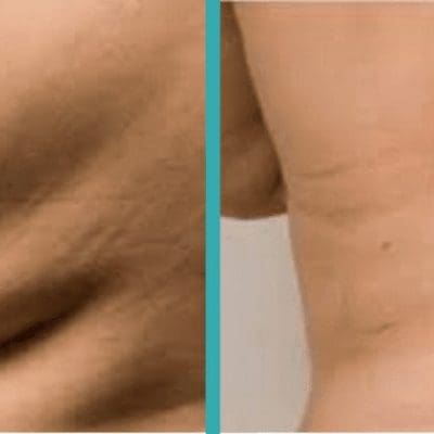 Before and after coolsculpting