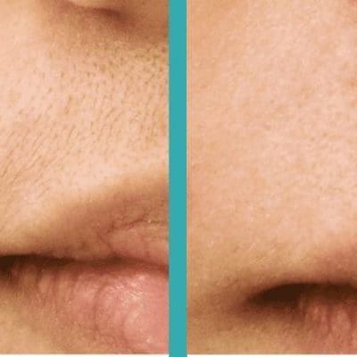 Lip laser hair removal chicago