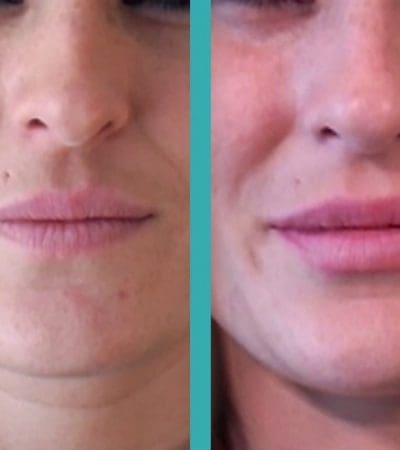 lip fillers before and after