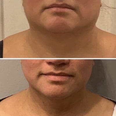 double chin reduction chicago